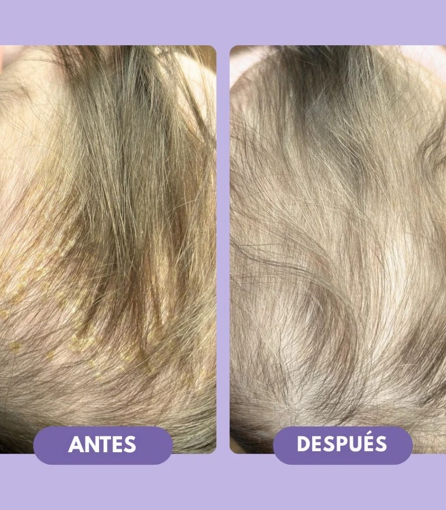 Champô de tratamento para a crosta láctea