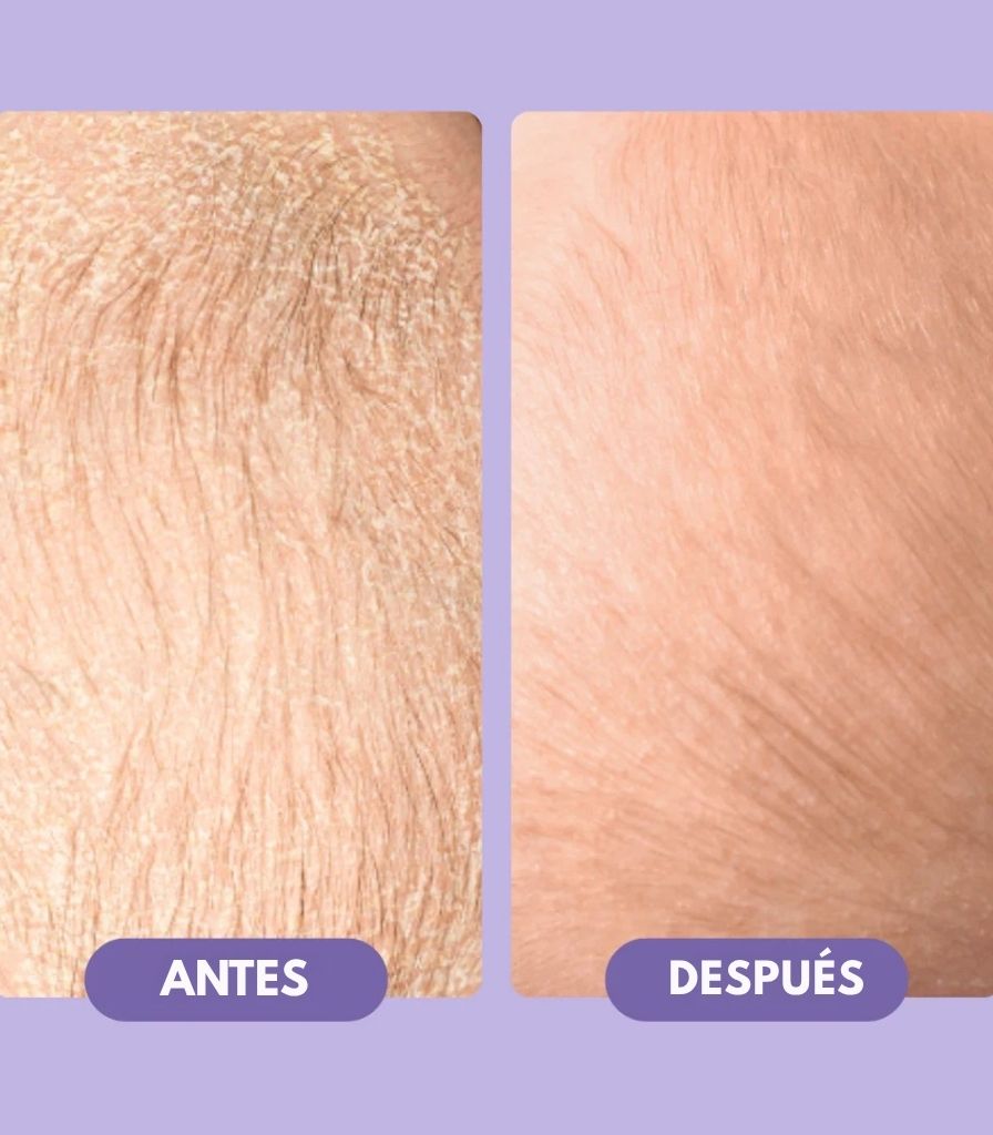 Champô de tratamento para a crosta láctea